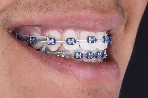 ORTODONCIA-BRACKETS-DESPUES-AM-DENTAL-STUDIO-3