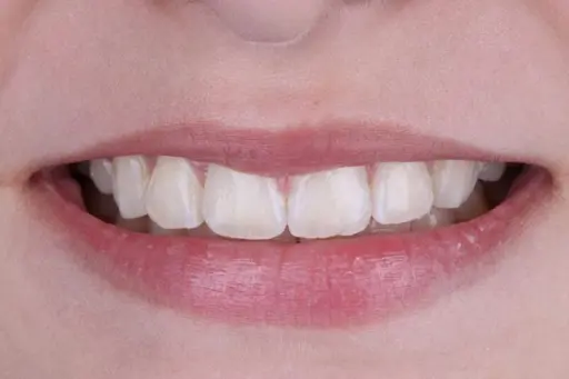 ORTODONCIA-BRACKETS-DESPUES-AM-DENTAL-STUDIO-5