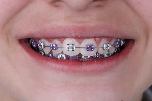 ORTODONCIA-BRACKETS-DESPUES-AM-DENTAL-STUDIO-2