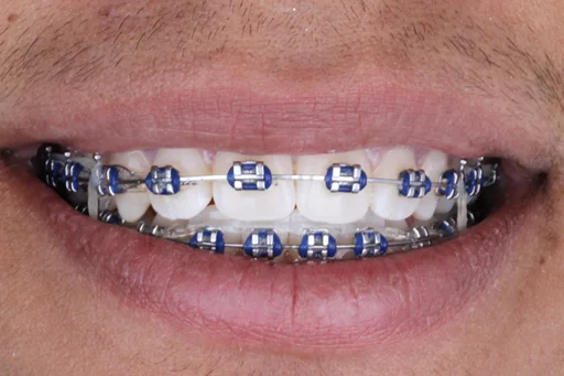 ORTODONCIA-BRACKETS-ANTES-AM-DENTAL-STUDIO-1