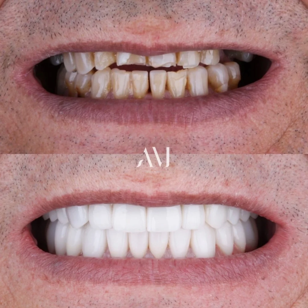 antes y despues de carrillas de porcelana AM Dental Studio Guadalajara Zapopan