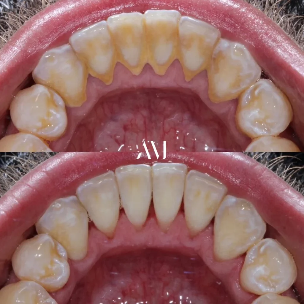 LIMPIEZA DENTAL ANTES Y DESPUES AM DENTAL STUDIO