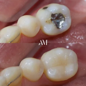 RESINA DENTAL AM DENTAL STUDIO