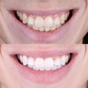 BLANQUEAMIENTO DENTAL antes y DESPUES AM DENTAL STUDIO 1