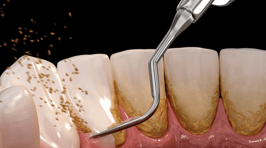 Raspado radicular AM Dental Studio