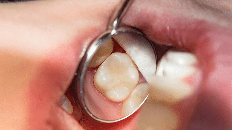 ¿Para qué se usa la resina dental?