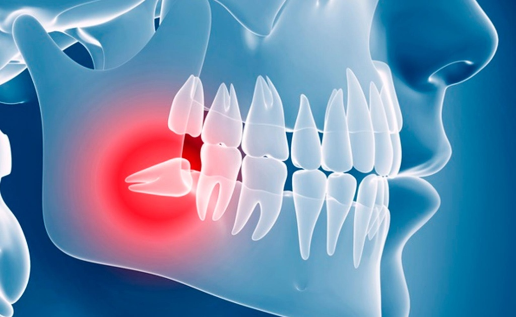 Primer plano de apiñamiento dental severo en el arco inferior, mostrando dientes encabalgados por falta de espacio en la mandíbula.