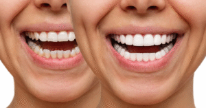 diseño de sonrisa fallido con dientes sobredimensionados