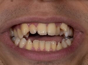 Mordida abierta anterior con espacio visible entre los dientes al cerrar la boca